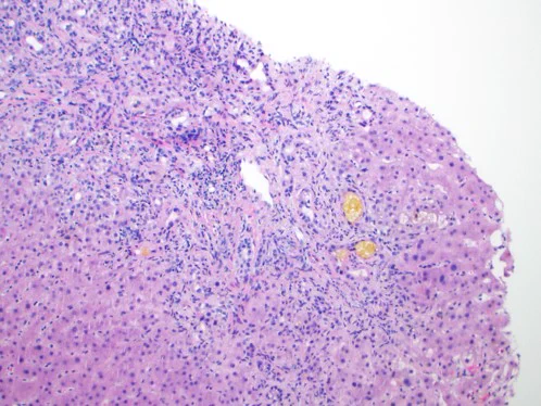 Post COVID cholangiopathy should be ruled out with follow up.