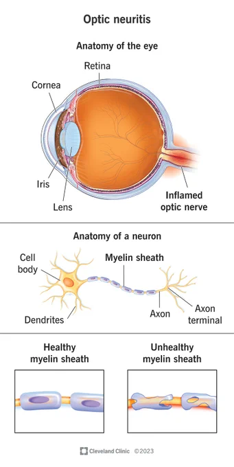 Illustration of an eye with an inflamed optic nerve, representing optic neuritis. 

Source: Cleveland Clinic