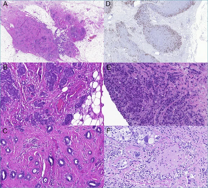 Histological variability in breast cancer. (Ferenczi & Cserni)