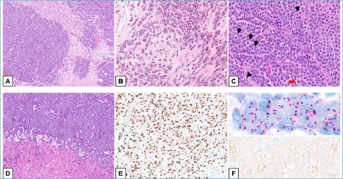 Pleomorphic/solid lobular carcinoma of male breast with PALB2 germline mutation. (Rogges et al)