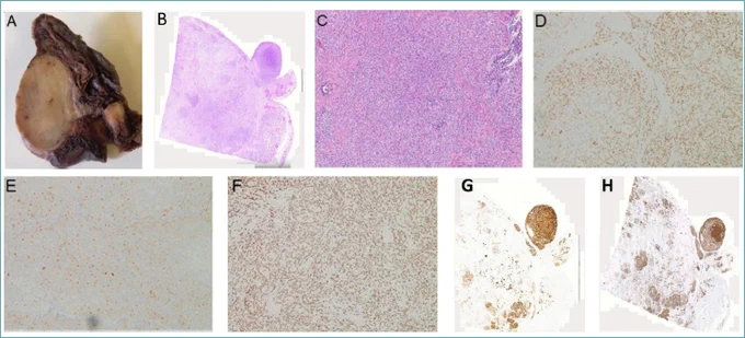 Metastasis of prostate adenocarcinoma to the testis. (Di Rienzo et al)