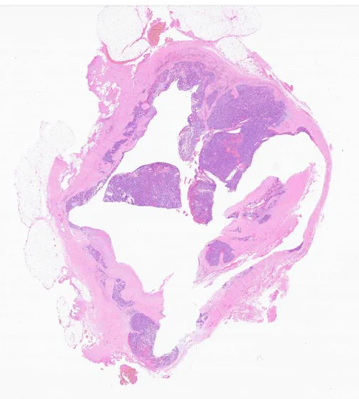 Gli1-altered mesenchymal tumor with lobulated (and cystic) architecture. 