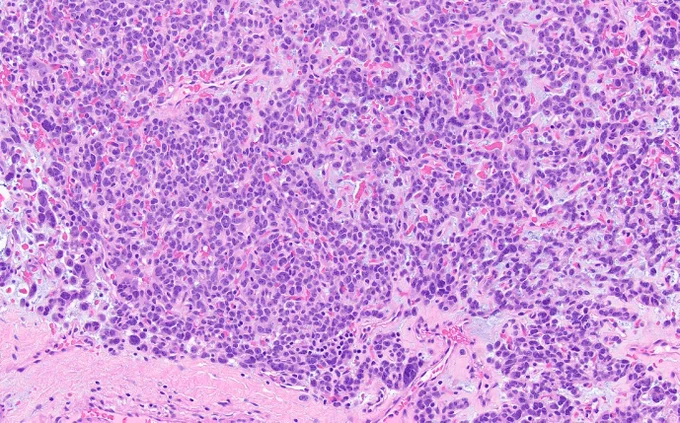 Tumor with both sheet-like and nested/reticular (shown) architecture. 