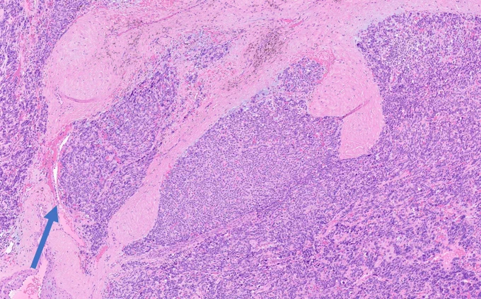 Lobulated tumor nests.   The tumor pushes against a slit like vascular space at the periphery (arrow). 