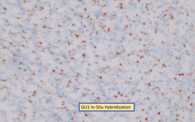 Gli1 in-situ hybridization  is positive