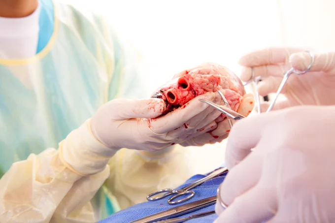 An image of a transplant surgery