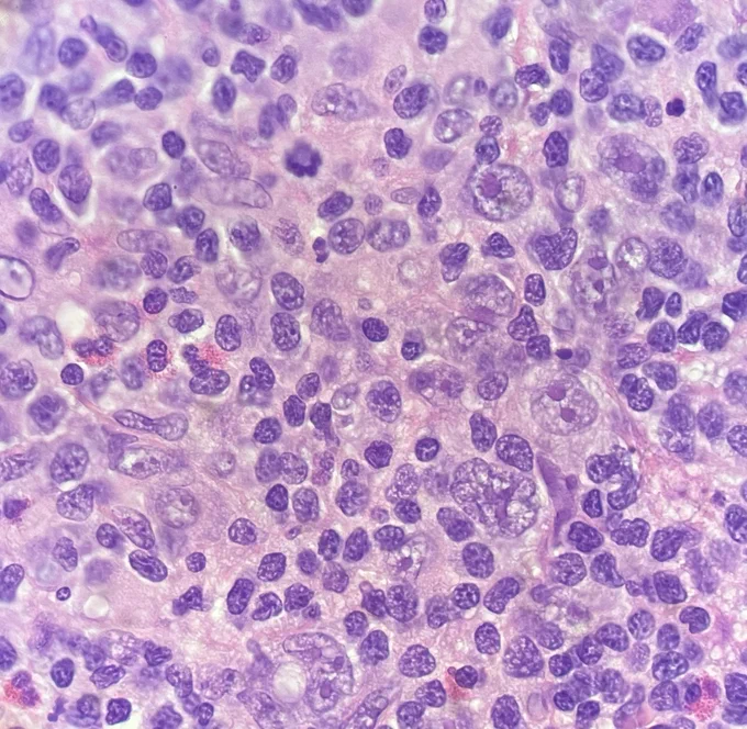 Lymph node tissue with Re Sternberg (RS) cells (those are the large cells) 