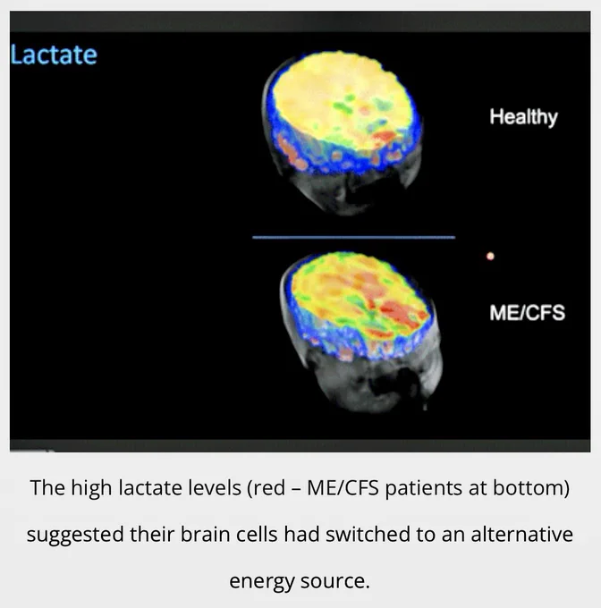 Brain: The high lactate levels (red - ME/CFS patients at bottom) suggested their brain cells had switched to an alternative energy source.