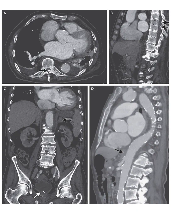 Initial CT Angiogram of the Chest, Abdomen, and Pelvis