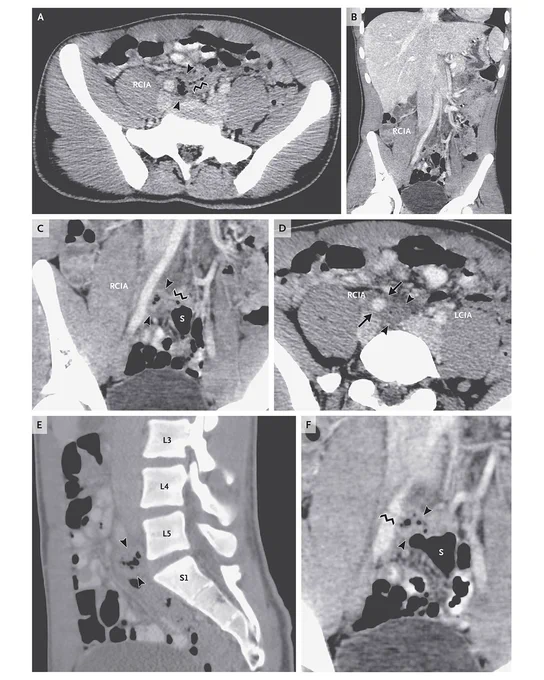 CT Scan of the Abdomen and Pelvis