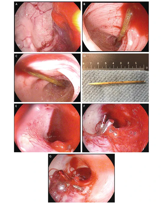 Images Obtained during Endoscopy