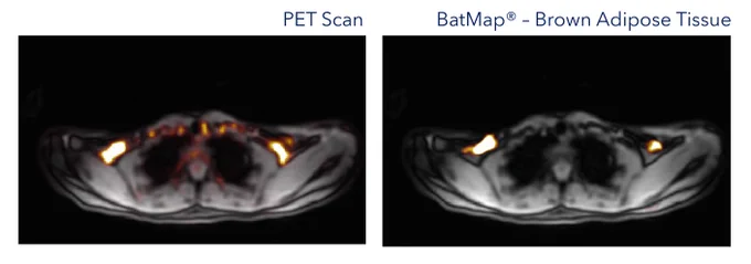 BatMap improves specificity by allowing fine tuning into fat deposits only.