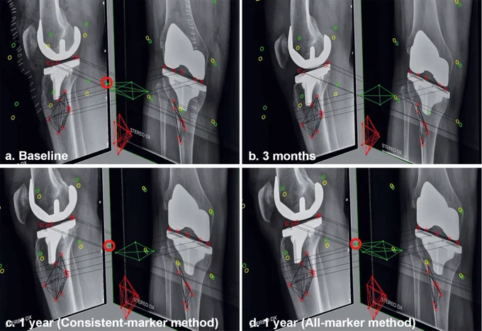 Figure 1. RSA examinations showing the baseline (a) and 3 months (b) follow-up exami-nation of a patients. At 3 months, the anterolateral marker (red circle) in the PE insert is  overprojected  by  the  implant  in  the  lateral  radiograph.  Using  the  consistent-marker  method, only 4 of the 5 markers in the PE insert are selected at the 1-year follow-up (c) for the migration calculation (as these are the markers used at the 3 months examina-tion).  With  the  all-marker  method,  all  5  available  markers  that  can  be  matched  to  the  reference examination are used for the migration calculation at the 1-year follow-up (d)