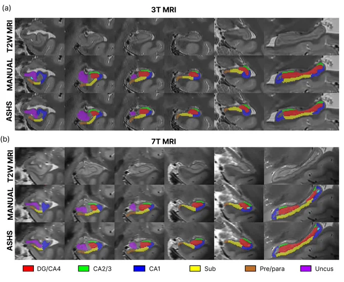 Hickling et al., Figure 2: See the automated protocol at work, compared to manual segmentation.