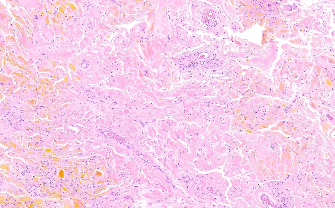 Amorphous eosinophilic material with scattered vessels. 