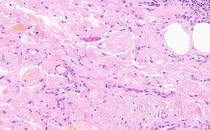 Eosinophilic material with foreign body giant cells. 