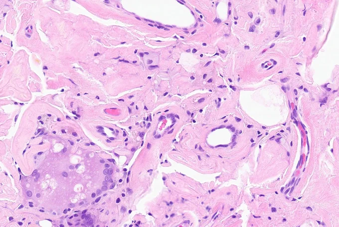 Massive foreign body giant cell with eosinophilic material wrapping around vessels. 