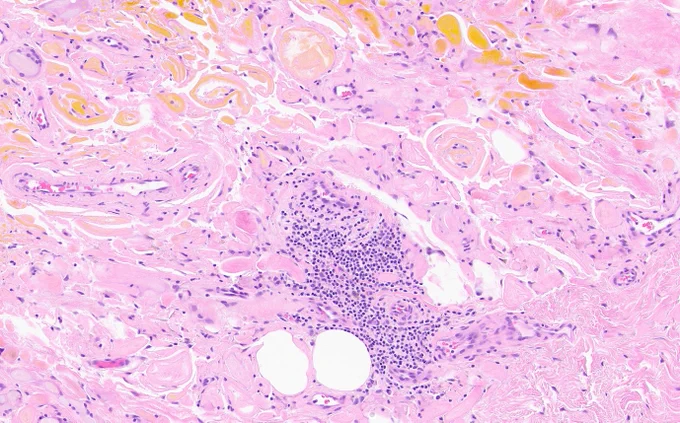 Focal area of chronic inflammation. 