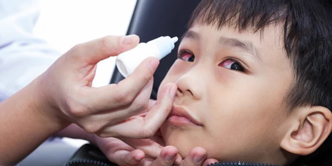 Closeup on child's face and adult's hand holding bottle of drops to one of the child's eyes. The white part of the eye is red