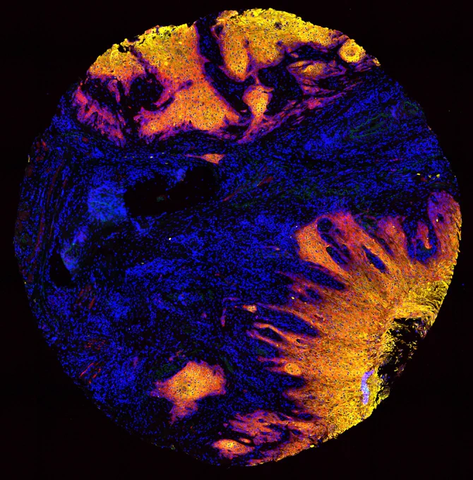 High-resolution microscopy image that illustrates how cancer cells invade healthy tissue in the oral cavity. © Sonja Fritzsche, Max Delbrück Center