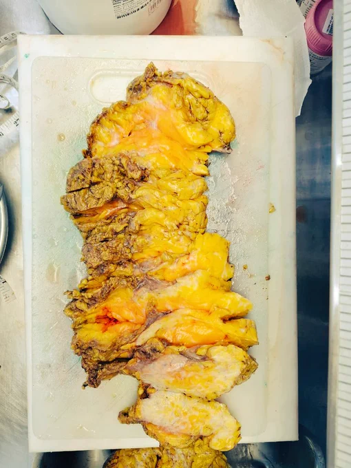 when a breast reduction specimen is grossed;. you can assume the grey_ white   Solid areas (bottom) are the actual gland part while the top yellow soft parts  as the  axillary part when Orienting ...however its always best when surgeon clears it for you...especially if suspicious for malignancy!
