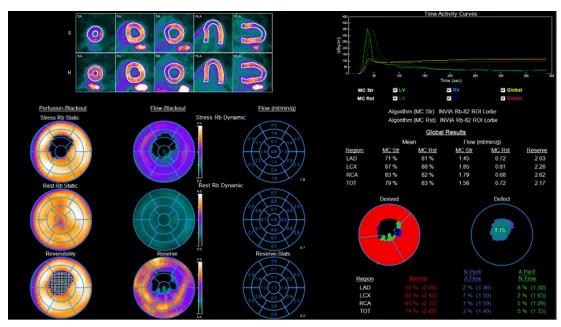 Myocardial blood flow