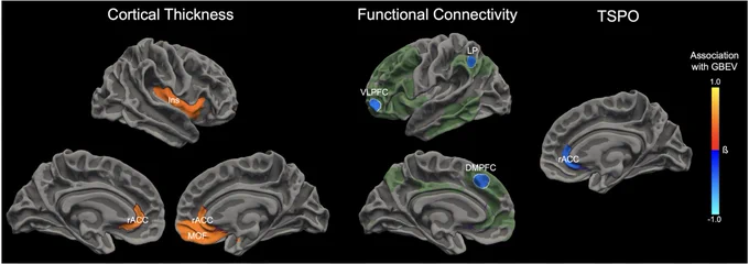 Associations between blast exposure and neuroimaging measures. Cumulative blast exposure was associated with alterations in measures of cortical thickness (Left), resting-state measures of functional connectivity (Middle), and measures of translocator protein (Right). For each modality, the anatomic regions that showed a significant association with blast exposure level in the adjusted regression models (controlling for age, combat exposure, and blows to the head) are superimposed on the surface of the brain. Orange colors indicate a positive association with blast exposure, whereas blue colors represent a negative association with blast exposure. 