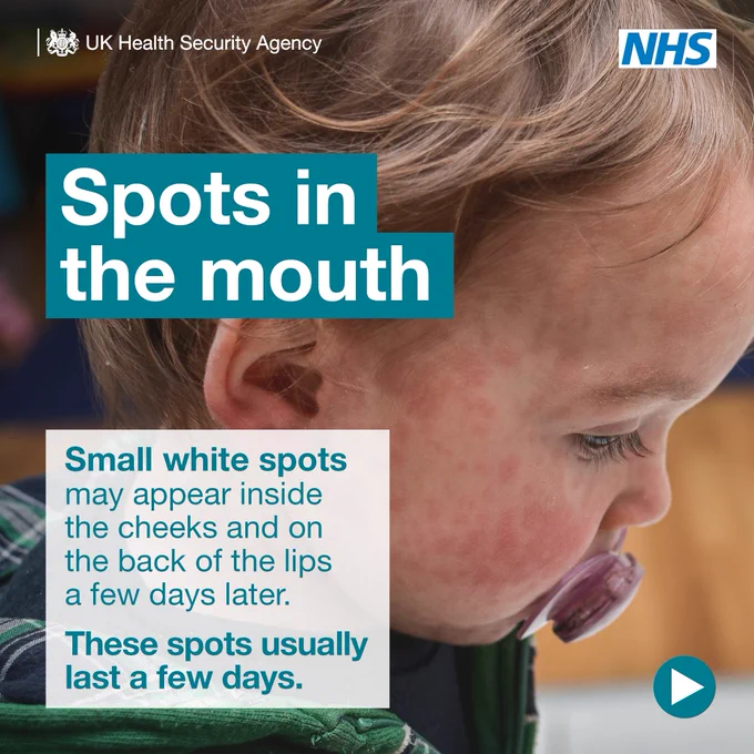 Spots in the mouth. Small white spots may appear inside the cheeks and on the back of the lips a few days later. These spots usually last a few days.