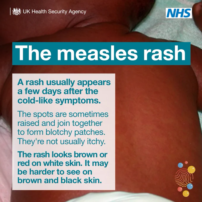 The measles rash. A rash usually appears a few days after the cold-like symptoms. The spots are sometimes

raised and join together to form blotchy patches. They’re not usually itchy. The rash looks brown or red on white skin. It may be harder to see on brown and black skin.
