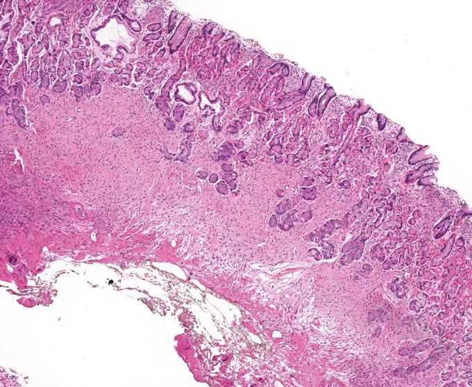 Gastric perineurioma (2019)