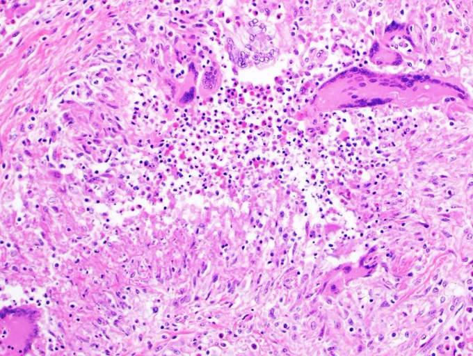 Colonic basidiobolomycosis (2021)