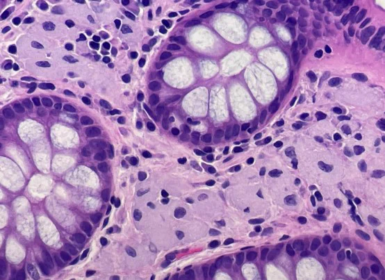 Colonic glycogen storage disease, IV (2023)