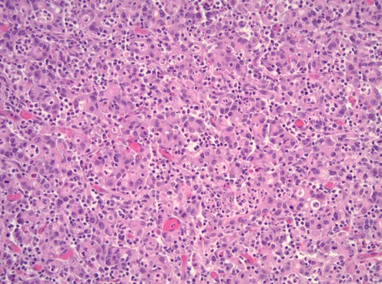 Duodenal LELC (2023)