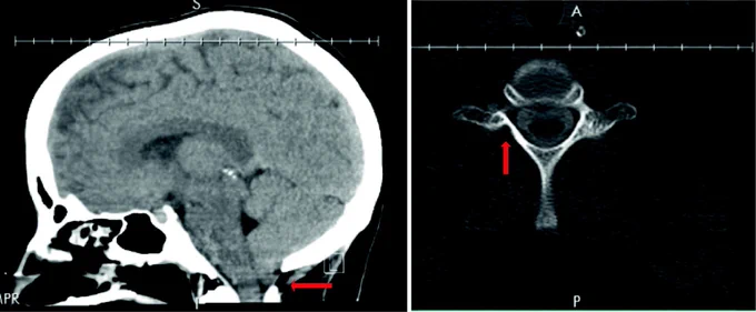 Panel A: Sagittal view of the brain with cerebellar sagging on the left, indicated by the arrow. Panel B: Small diverticulum along the peripheral nerves on the right (thoracoabdominal region), indicated by the arrow.