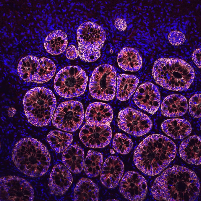Wild-type intestinal organoid after 10-week transplant stained for nuclei (DAPI, blue), epithelial cells (CDH1, white) and intestinal epithelial cells (CDH17, red).