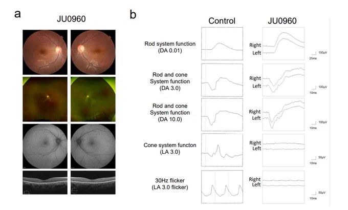 Screenshot of Figure 1. Clinical findings from a representative patient (JU0960). (a) Multimodal retinal imaging showed a normal appearance by fundus photograph (first and second panels) and fundus autofluorescence imaging (third panel), and blurred outer retinal layer ellipsoid zone by OCT (fourth panel). (b) Full-field electroretinography showed normal rod system function (DA 0.01) and combined rod and cone system functions (DA 3.0 and DA 10.0) with unrecordable cone system function (LA 3.0) and 30-Hz flicker responses (LA 3.0 flicker).
