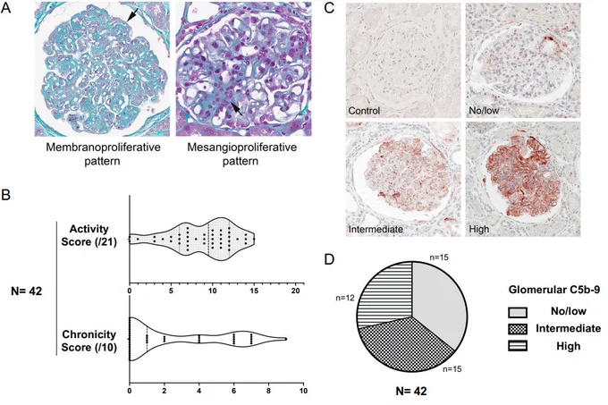 Histological and C5b-9 deposits evaluation in C3 glomerulpathy
(a) Representative images of main glomerular patterns: membranoproliferative on the left (arrow indicates glomerular basement membrane duplication) and mesangioproliferative on the right (arrow indicates mesangial cell hypercellularity). Two kidney biopsies did not belong to either of this two patterns: one showed extensive mesangial and parietal deposits, and the other one displayed non significant glomerular lesions on light microscopy (b) C3 glomerulopathy histological index quantification in kidney biopsies: activity and chronicity scores. Violin plot, each individual value is represented by a point. (c) Representative images of glomerular C5b-9 in negative control and C3 glomerulopathy biopsies classified as no/low, intermediate and high. (d) Repartition of kidney biopsies among the 3 glomerular C5b-9 groups.