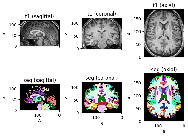 MRI image and segmentation after slicing.