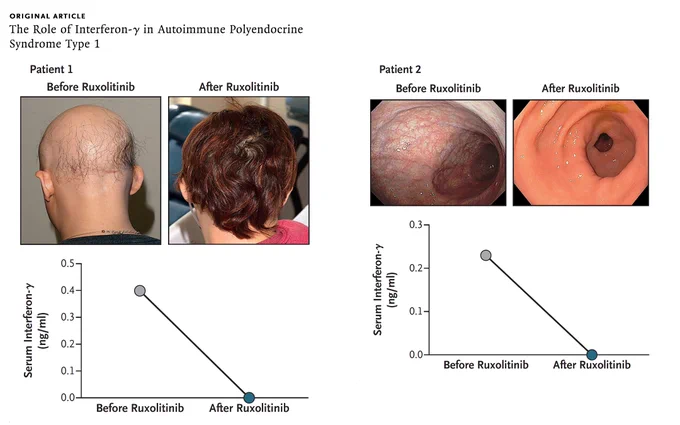 Original Article
The Role of Interferon-γ in Autoimmune Polyendocrine Syndrome Type 1

Panel A shows photographs of hair on the scalp of Patient 1 before and after ruxolitinib treatment. The graph shows serum levels of interferon-γ before and after treatment. Panel B shows the macroscopic appearance of gastric mucosa during endoscopy in Patient 2. The graph shows serum levels of interferon-γ before and after treatment.