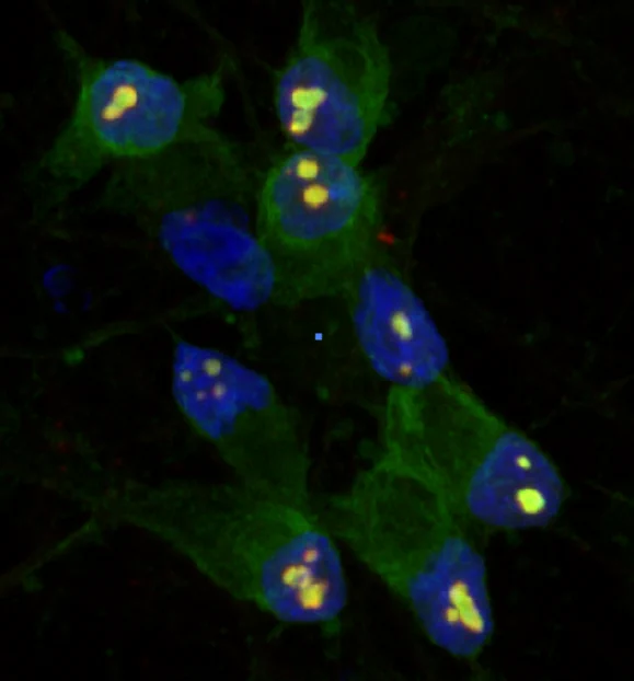Neuronal intranuclear TDP-43 aggregates
