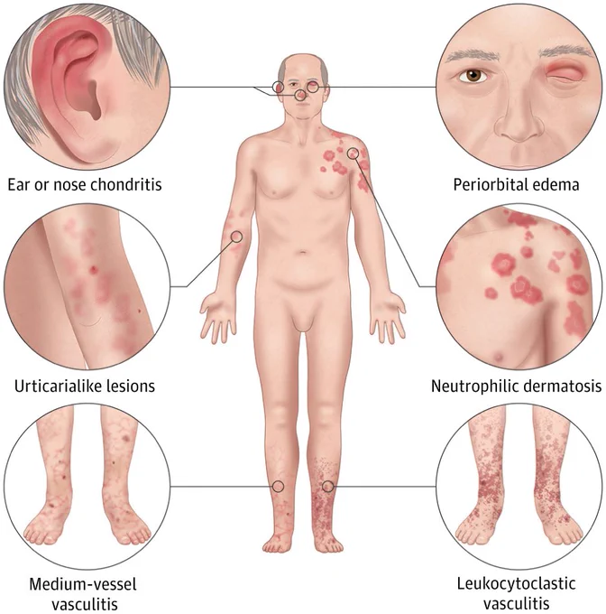 A graphic from the paper with illustrated depictions of ear or nose chondritis, urticarialike lesions, medium-vessel vasculitis, periorbital edema, neutrophilic dermatosis, and leukocytoclastic vasculitis on a person.