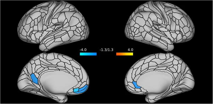 Alterations of the Default Mode Network (DMN) connectivity strength are primarily localized in nodes of ventromedial prefrontal cortex (specifically, nodes of the left medial orbitofrontal, and of the right rostral anterior cingulate) and in the left precuneus. https://rdcu.be/dLpKy