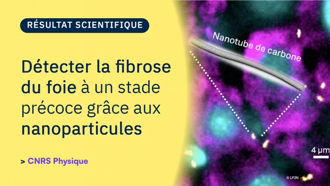 Vignette Résultat Scientifique de CNRS Physique.

Titre de l'actualité : Détecter la fibrose du foie à un stade précoce grâce aux nanoparticules

Référence de la publication : Identification of early-stage liver fibrosis by modifications in the interstitial space diffusive microenvironment using fluorescent single-walled carbon nanotubes. A. Lee, A. A. Simon, A. Boyreau, N. Allain-Courtois, B. Lambert, J.-P. Pradère, F. Saltel, L. Cognet, Nano Letters, publié le 26 Avril 2024.

Figure :: La détection de nanotubes de carbone diffusant dans l’espace interstitiel de tissus de foie et l’analyse de leurs mouvements nanométriques (zones brillantes en jaune) permettent de détecter la présence de fibrose hépatique à un stade très précoce dans un modèle murin.  (Colorations violette et bleue : cellules hépatiques) © LP2N