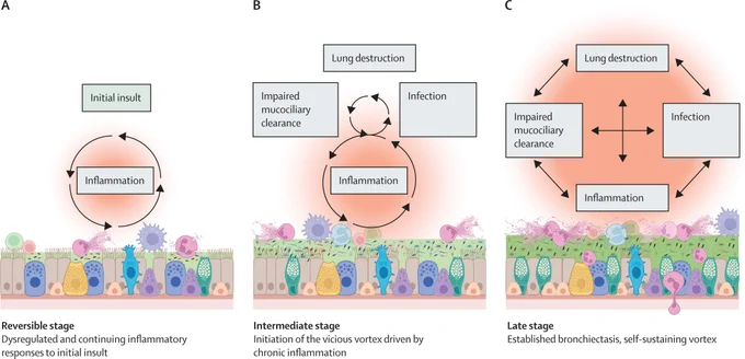 Figure showing the role of inflammation in the initiation and progression of bronchiectasis. Copyright: Elsevier Ltd. All rights are reserved.