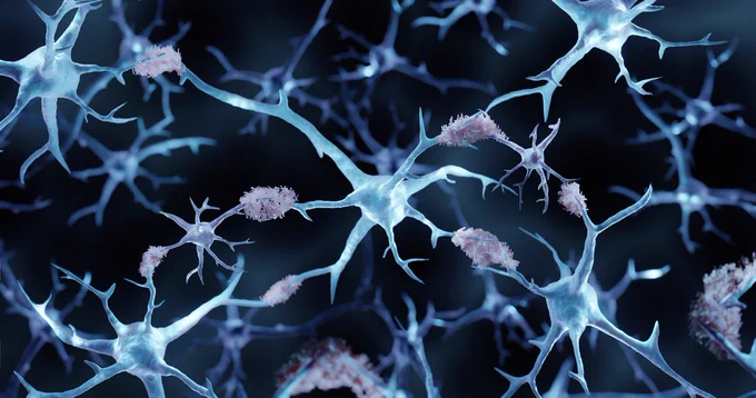 Amyloid plaques forming in a brain with Alzheimer's. Image credit: ART-ur via Shutterstock. 