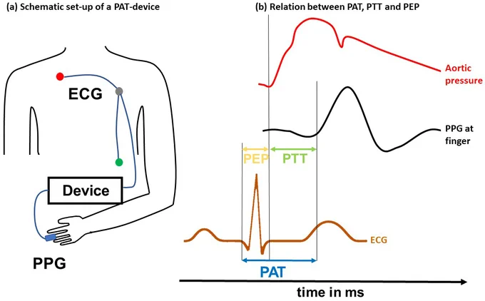 Fig. 1.
PWV surrogate parameters. The left panel (a) shows the schematic set-up of a pulse arrival time measurement device. An electrocardiogram (ECG) is placed on the patient’s thorax. A photoplethysmography (PPG) sensor is placed at the peripheral side (e.g., at the finger). Both devices are interconnected with a data recorder. The right panel (b) shows the relationship between the pre-ejection period, pulse transit time, and pulse arrival time.