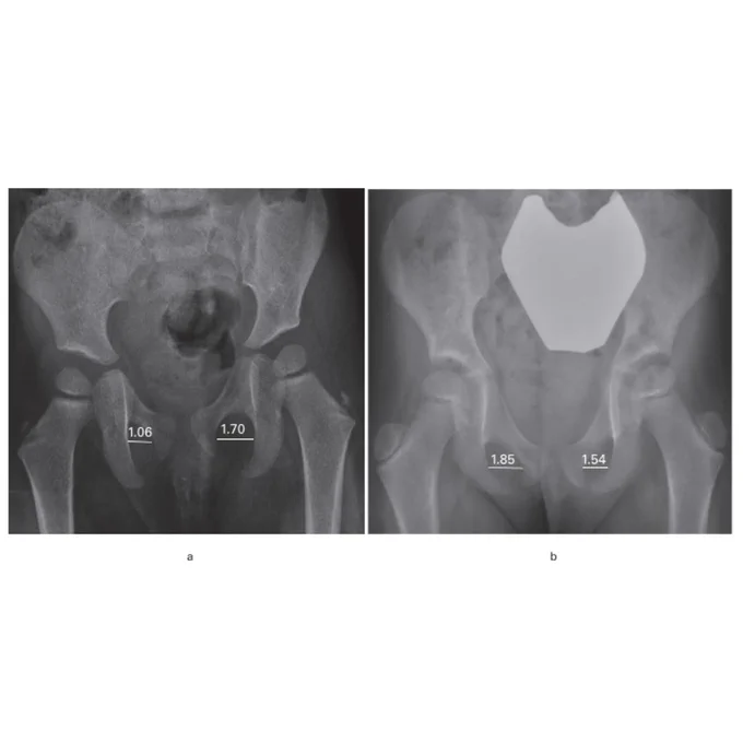 Image depicts example of obturator foramen diameter ratio for validating anteroposterior pelvis radiograph. 

Measurement was:
a) 0.62 at two years
b) 1.20 at five years.