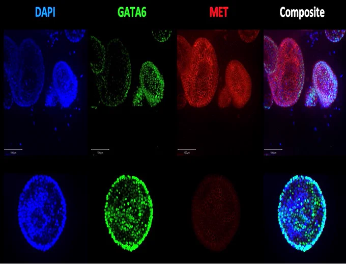The image depicts pancreatic cancer organoids derived from ultrasound-guided fine-needle biopsies. GATA6 and MET are markers of molecular subtypes. Photo credit: Aida Marisch Delgado