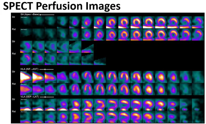 SPECT perfusion images