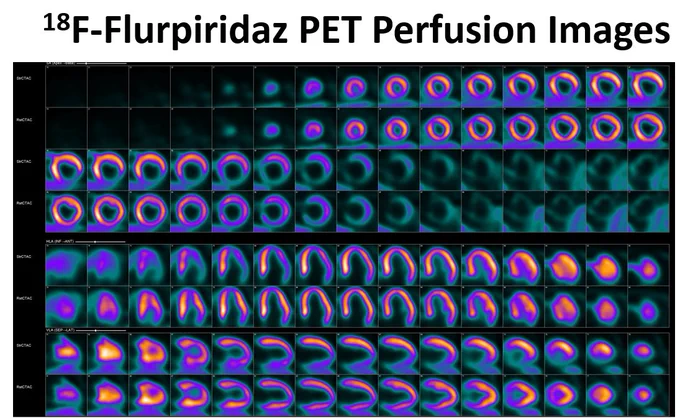 F-18 flurpiridaz PET perfusion images 